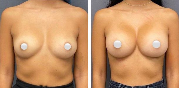 Breast Augmentation - Patient 18