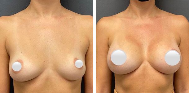 Breast Augmentation - Patient 19