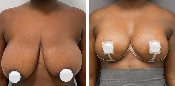 Breast Lift with Implants Patient 12