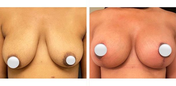 Breast Lift with Implants Patient 11
