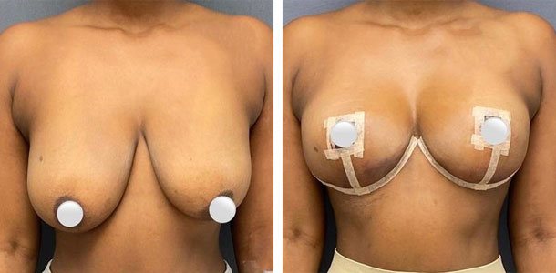 Breast Reduction Patient 3