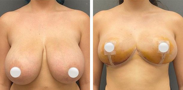 Breast Reduction Patient 5