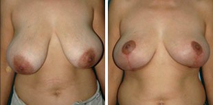 Breast Reduction Patient 2