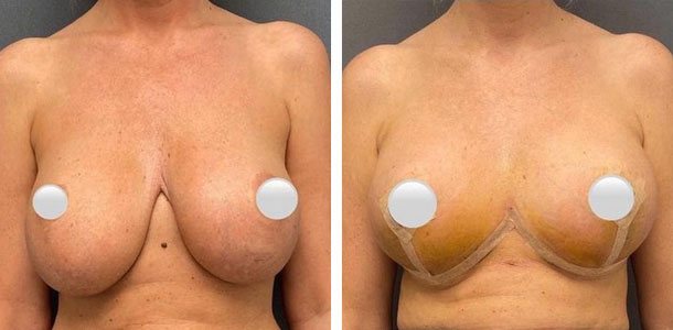 Breast Revision Patient 12