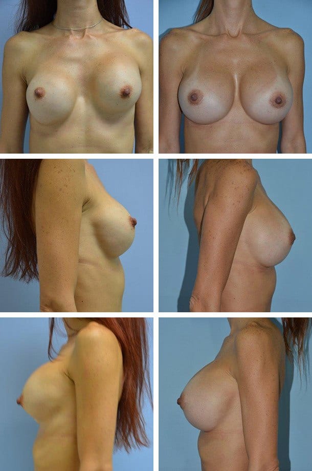 Breast Revision Patient 2