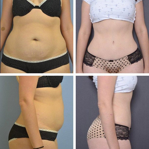 https://www.arykraumd.com/wp-content/gallery/tummy-tuck/tummy-tuck.jpg