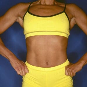 How Can I Minimize My Tummy Tuck Scar?