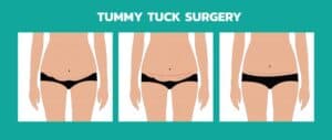 Tummy Tuck in Miami