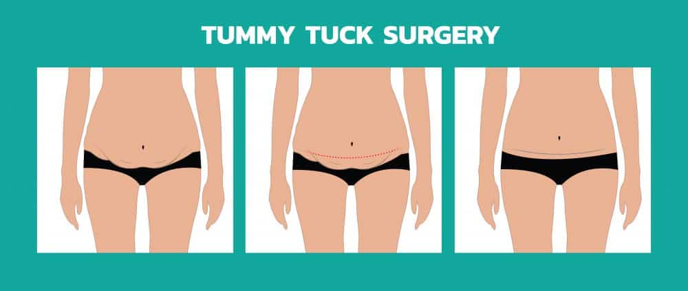 Tummy Tuck in Miami