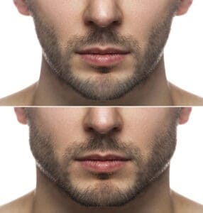 Chin Augmentation in Miami