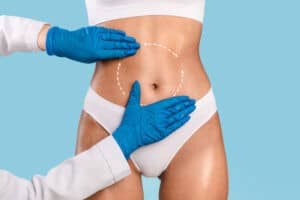 flat tummy liposuction