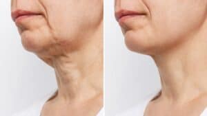 before and after turkey neck Miami